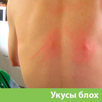 Укусы блох в Владикавказе