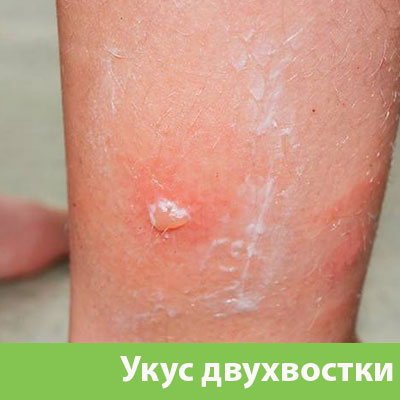 Укус двухвостки в Владикавказе