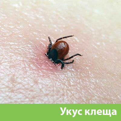 Укус клеща в Владикавказе