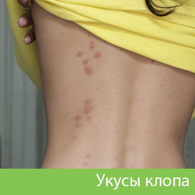 Профессиональное уничтожение клопов в Владикавказе
